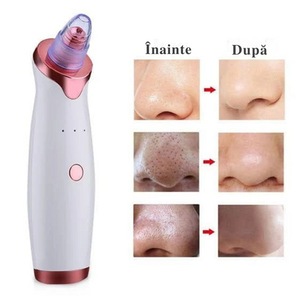 Extractor de acnee – Curățare Eficientă și Fără Durere